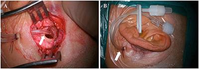 Long-term efficacy of dexamethasone treatment via tympanic antrum catheterization for intractable Meniere's disease